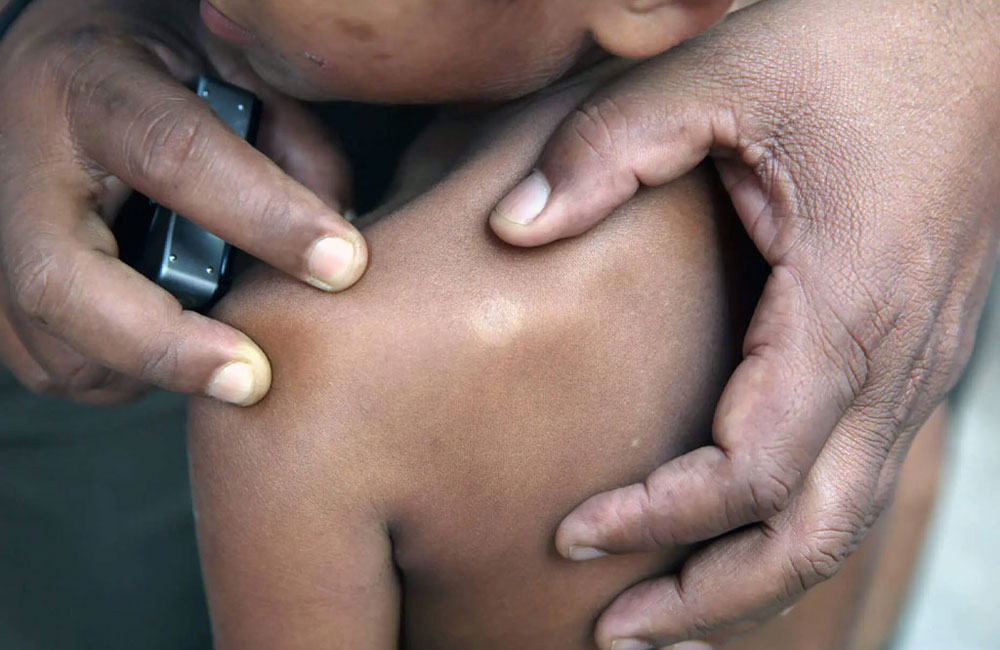 Children Among the Infected: Sri Lanka Reports 1,282 Leprosy Cases in 2025