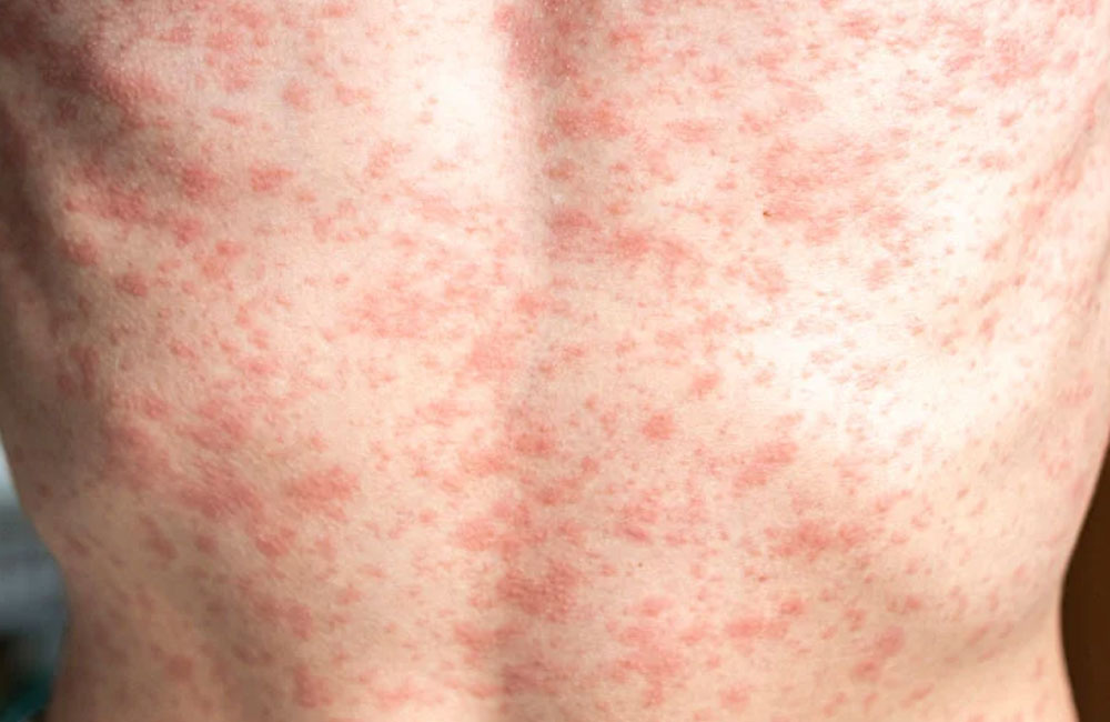 Measles Reappears in Sri Lanka After Years of Elimination, Health Officials Warn