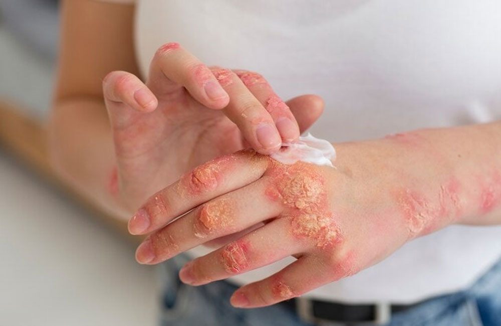 Skin Diseases Emerging as a Growing Public Health Concern: Dermatologist 